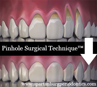 Pinhole Surgical Technique (PST)